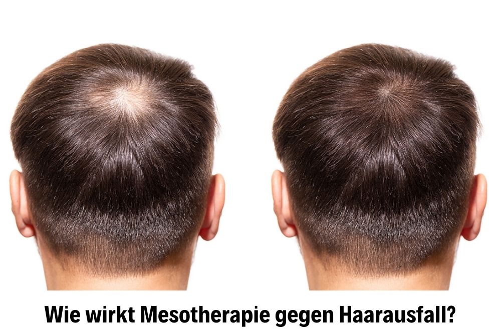 Haar Mesotherapie